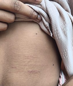 Injury