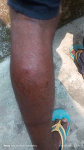 Gomia: Youth injured in jackal attack; panic among villagers.